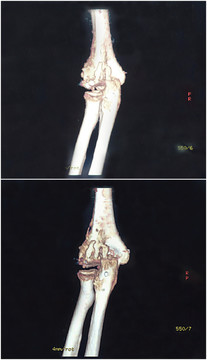 肘關(guān)節(jié)CT掃描3D圖像