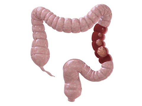 結(jié)腸癌