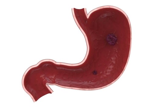 胃潰瘍
