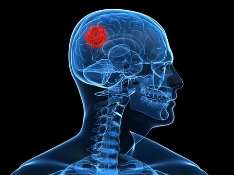腦腫瘤