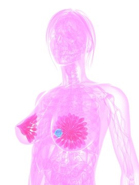 乳腺癌的插圖