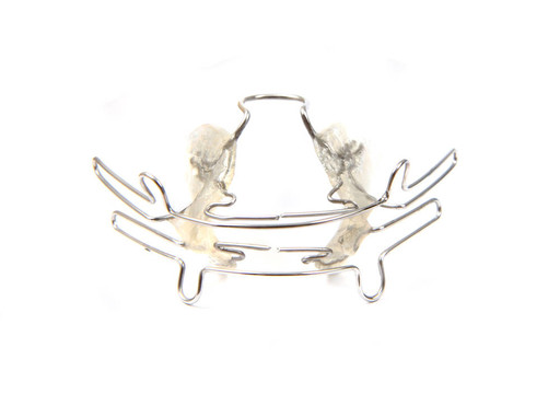 大括號（正畸工具）