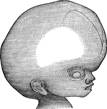 腦積水；老式雕刻。