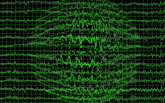 腦電波encephalogramme腦電圖