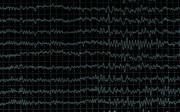 在encephalogramme腦波