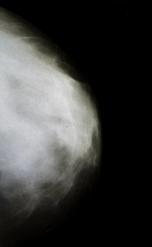 女人的乳房X射線