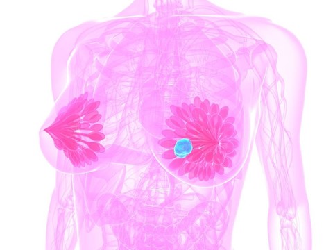 乳腺癌的插圖