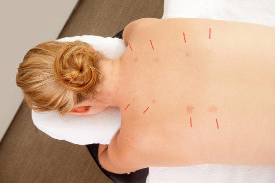 后Shu Acupuncture點