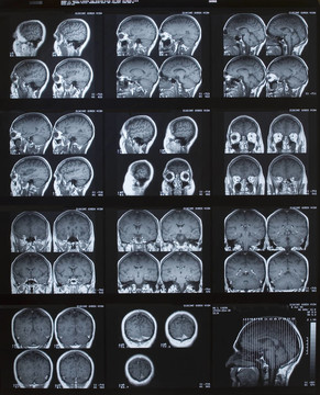 腦MRI