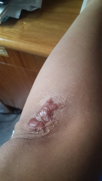 疤痕