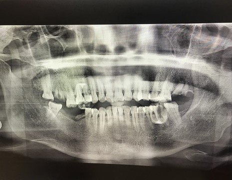 牙齒X光片