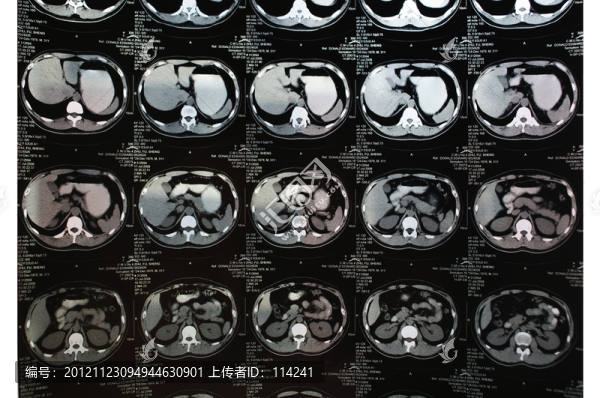CT片子