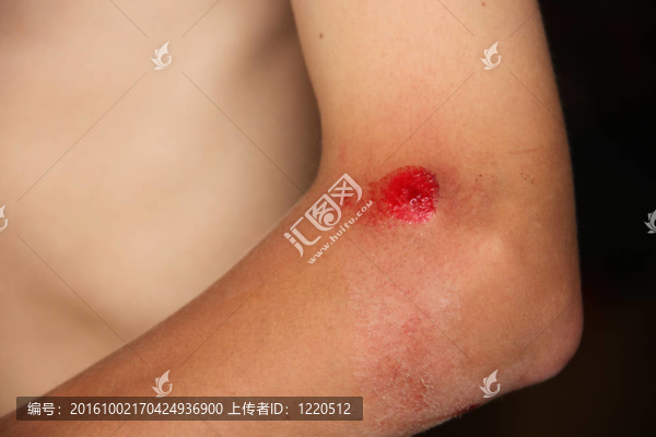 擦傷流血肘