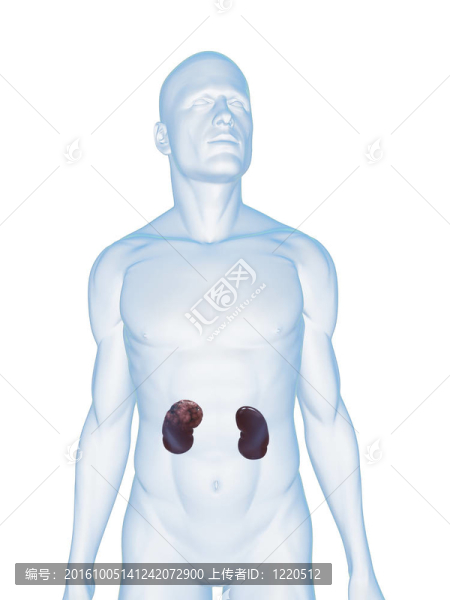 腎細胞癌