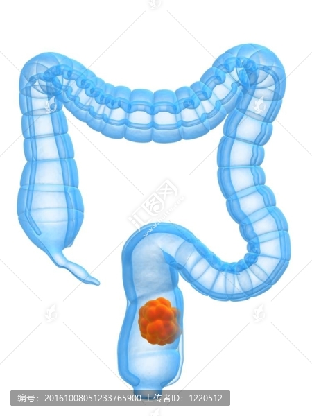 結(jié)腸癌