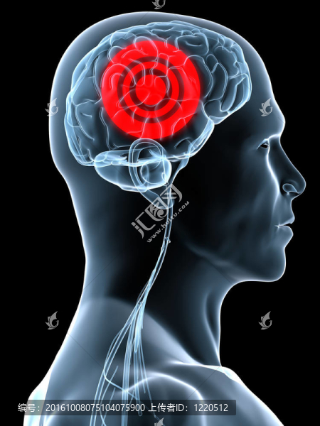 頭痛migraene