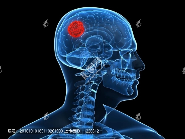腦腫瘤