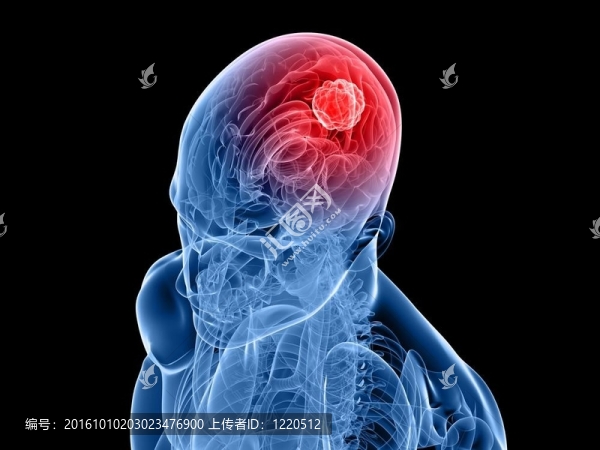 腦腫瘤