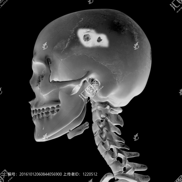 顱腦損傷后3d影像