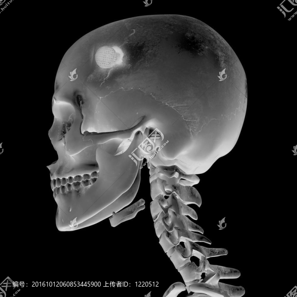 顱腦損傷后3d影像