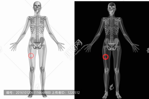 人體解剖-斷裂右股骨
