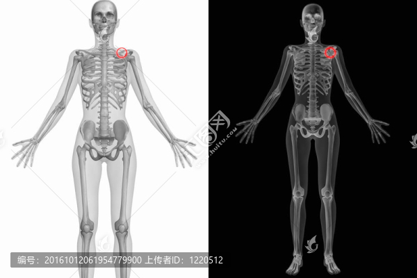 人體解剖學-破碎的左肩胛骨