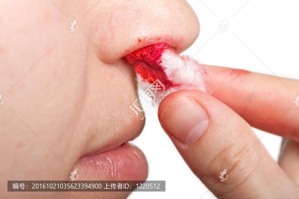 鼻出血