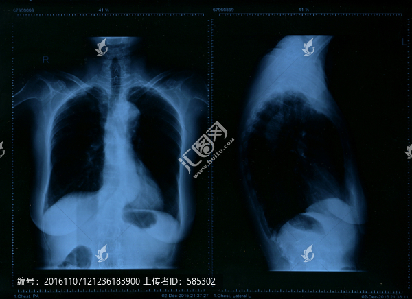 胸部正側(cè)面x光照片