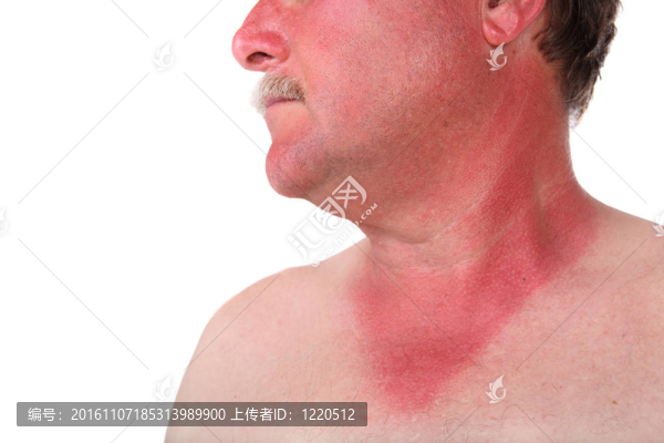 被曬傷的人
