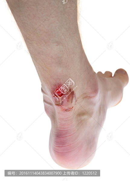 腿上的傷口-匯圖網(wǎng) www.fosd68.com 腿上的傷口