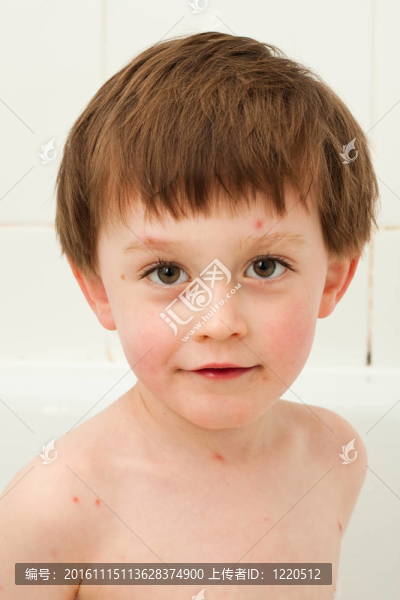 水痘