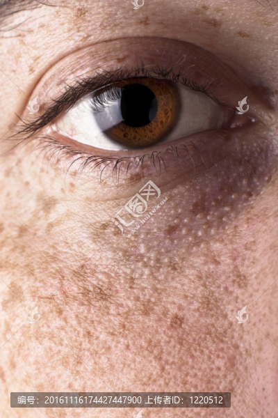 眼部有雀斑