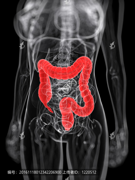 突出女性結(jié)腸癌