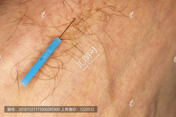 針刺療法