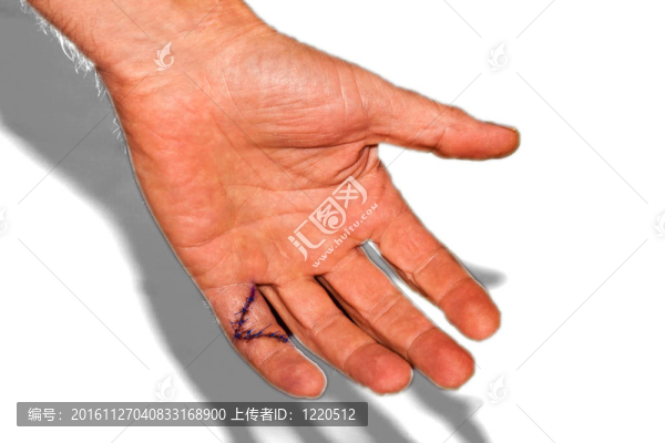 手術(shù)后小手指縫合