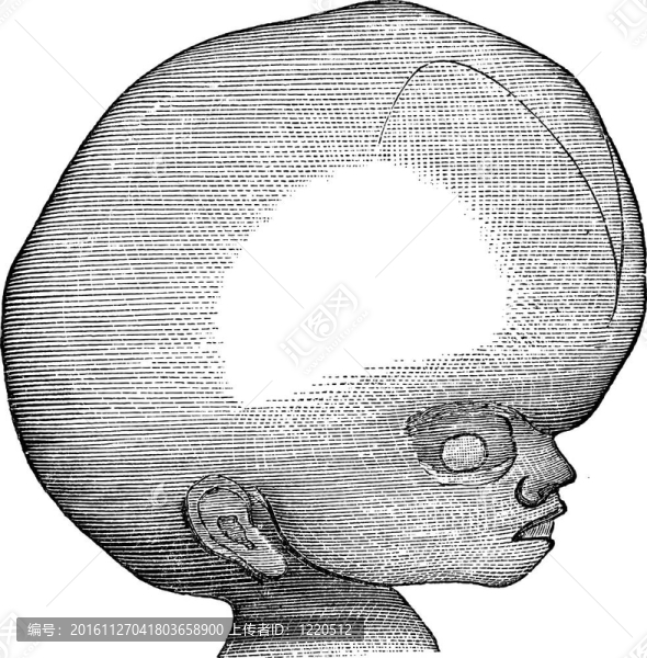 腦積水；老式雕刻。