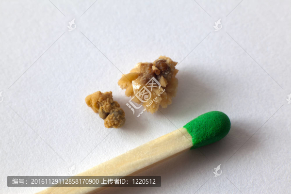 腎結石