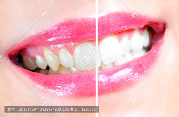 牙齒美白