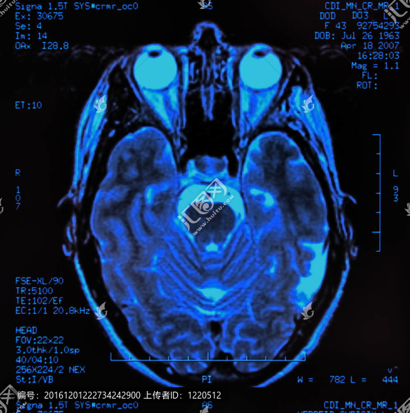 腦MRI