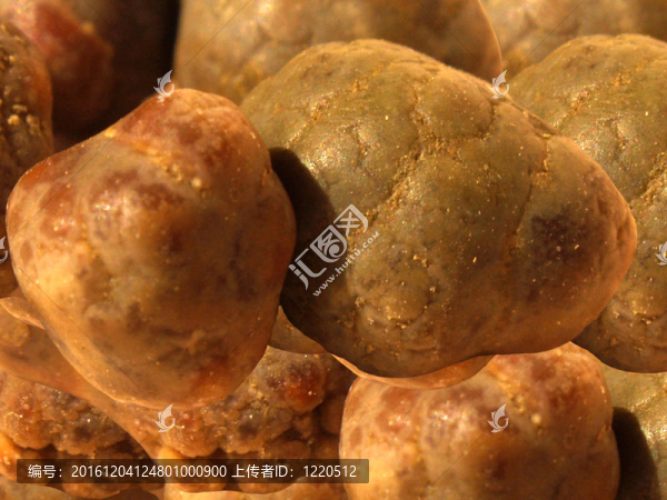 膽結(jié)石