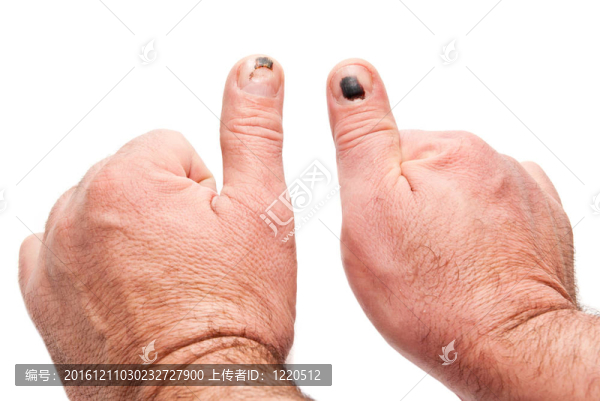 拇指損傷
