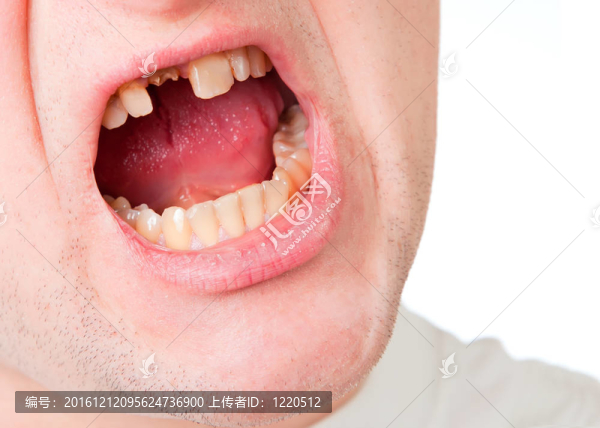 年輕人面對(duì)破碎的牙齒