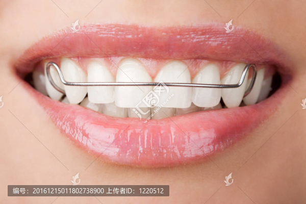 牙齒保持器