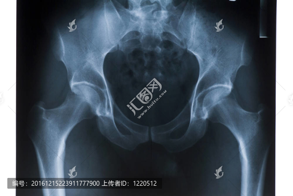 股骨的造影顯示一些割傷