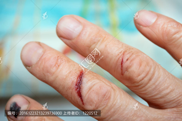 通過手指的手外傷