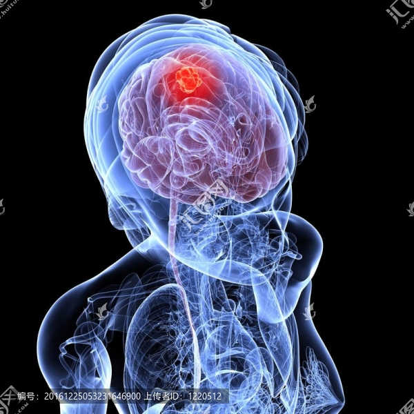 腦腫瘤