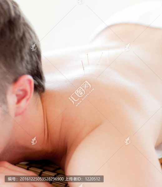 一個白人男子接受針灸治療的特寫鏡頭