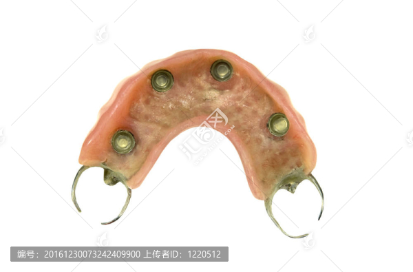鋼環(huán)部分義齒