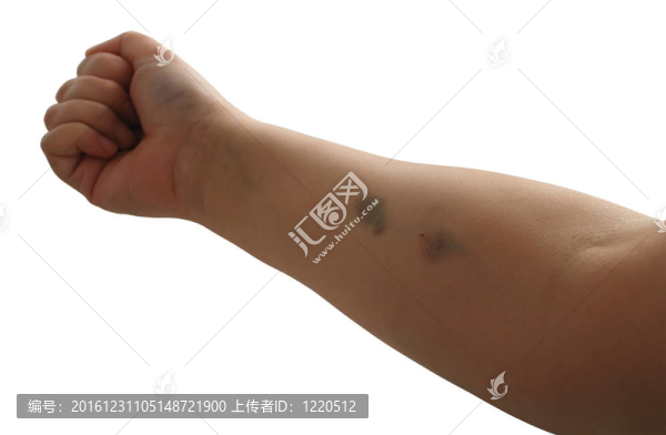 手臂注射挫傷和閉合拳頭