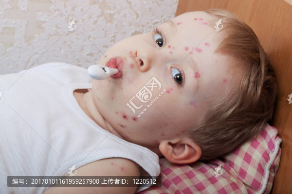 與水痘的小男孩的肖像